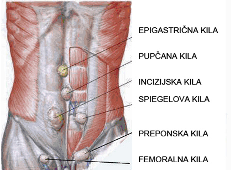 Hernija (kila)
