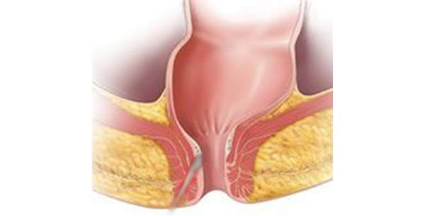Anorektalna fistula